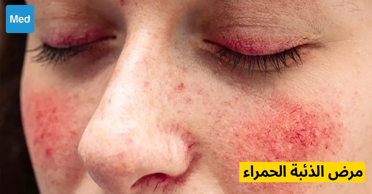 الذئبة الحمراء : فهم هذا المرض المناعي الذاتي